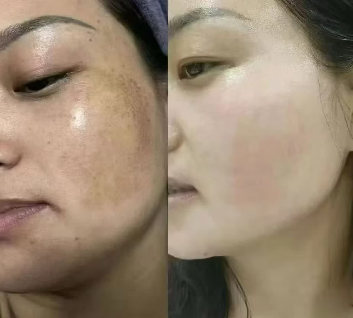 担心买不到口碑好的氢醌乳膏？台湾寿元原厂合规款来帮你！